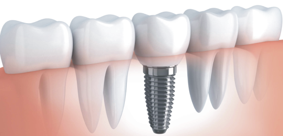 Especialização Em Implantodontia Com Habilitação Em Odontologia Digital Apcd Associação